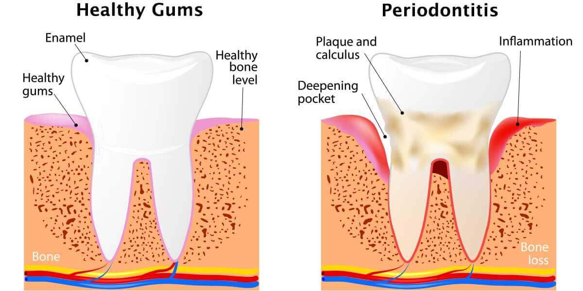 Image Comparing Health Gums and Periodontitis 