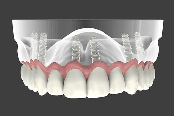 Implant Supported Dentures - Patient Smile