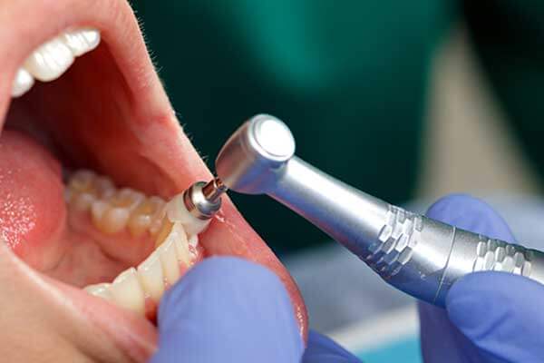 Cleaning tool removing dental plaque from teeth