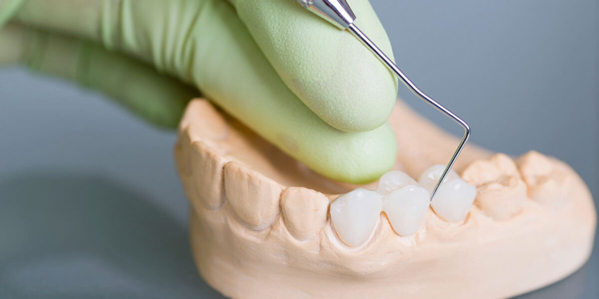 Dental Bridge Model 