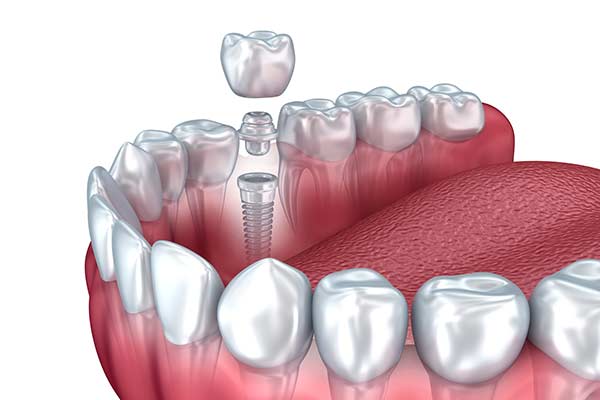 Single Dental Implant