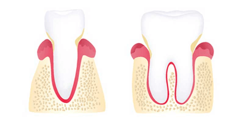 Early Stage Periodontitis