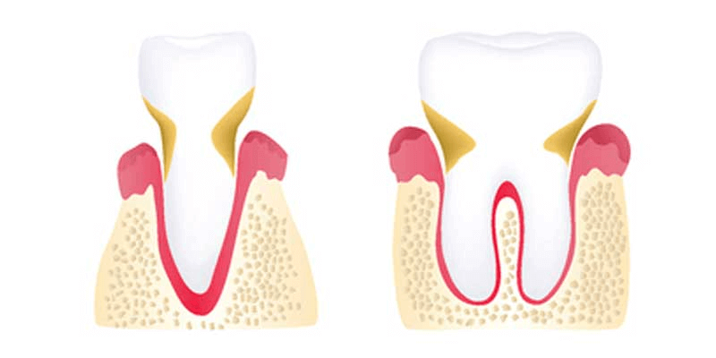 Moderate stage periodontitis