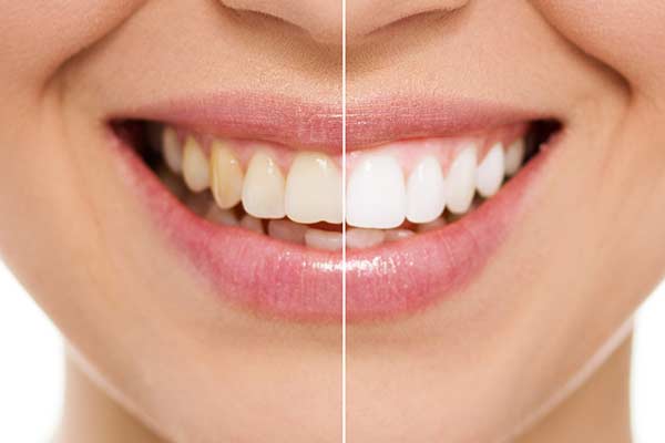 Before & After Teeth whitening 