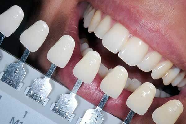 Composite Fillings Shade Guide